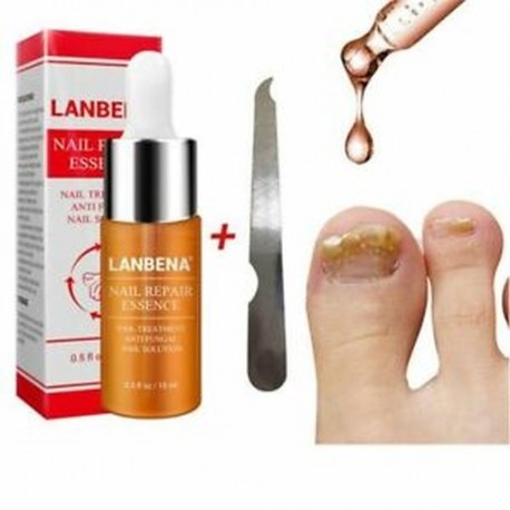 LANBENA körömkezelő krém Fényes gombás körömjavító Remonti U5F1 onchomycosis onchomycosis