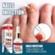50 ml Nail Repair Essence szérum gombaellenes körömápoló körömgomba eltávolítása tápláló kéz Láb lábujjak