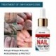 50 ml Nail Repair Essence szérum gombaellenes körömápoló körömgomba eltávolítása tápláló kéz Láb lábujjak
